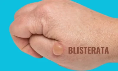 Blisterata: The Ultimate Guide to Understanding