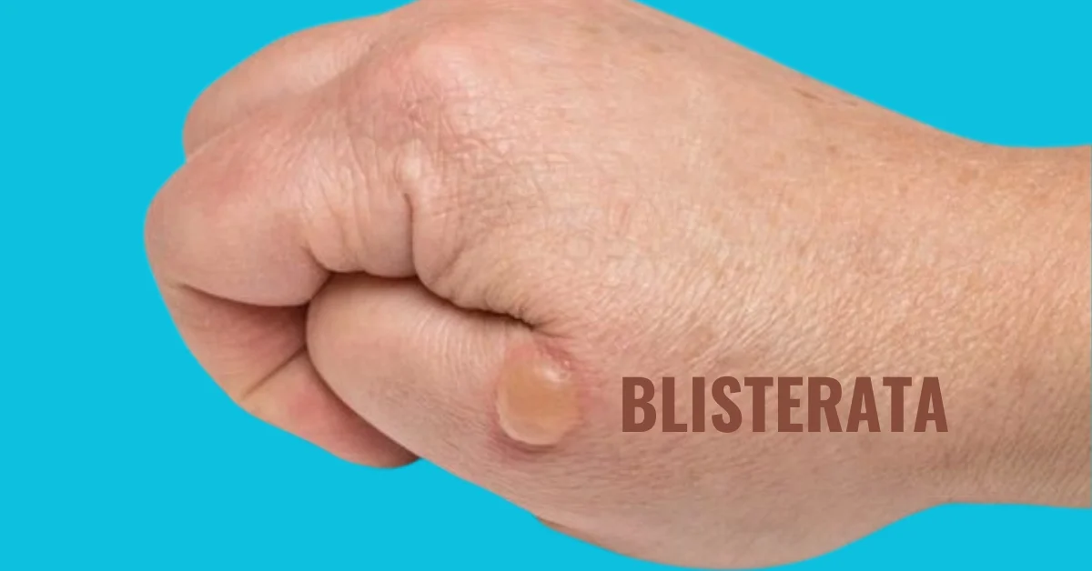 Blisterata: The Ultimate Guide to Understanding